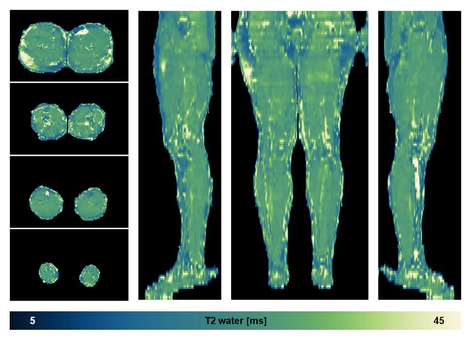 The water only T2 relaxation time of the lower extremity obtained from multi echo spin echo t2 mapping with EPG based reconstruction.